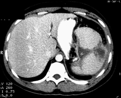 Splenic Abscess - CTisus CT Scan