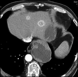 Islet Cell Tumor With Liver Metastases Invades the Spleen - CTisus CT Scan