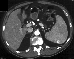 Splenic Hemangioma - CTisus CT Scan