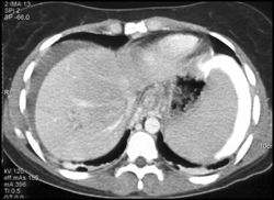 Contrast Extravasation Around the Spleen - CTisus CT Scan