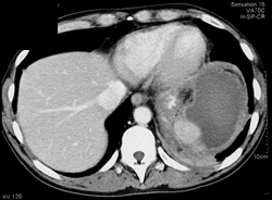 Splenic Abscess - CTisus CT Scan