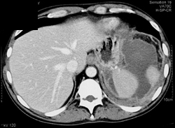 Splenic Abscess - CTisus CT Scan