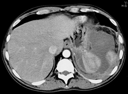 Splenic Abscess - CTisus CT Scan