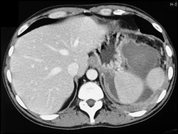 Splenic Abscess - CTisus CT Scan