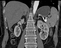 Splenic Artery Aneurysm - CTisus CT Scan