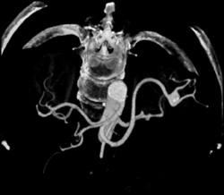 Splenic Artery Aneurysm - CTisus CT Scan