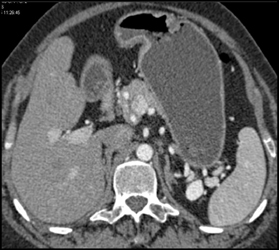 Splenic Artery Aneurysm - CTisus CT Scan