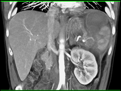 Splenic Laceration With Bleed and Subcapsular Hematoma - CTisus CT Scan