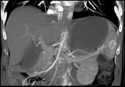 Splenic Hemangiomas - CTisus CT Scan