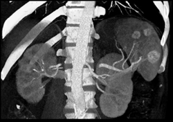 Splenic Hemangiomas - CTisus CT Scan