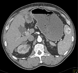 Splenic Hemangiomas - CTisus CT Scan