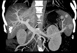 Splenic Hemangiomas - CTisus CT Scan