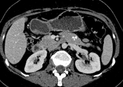 Splenic Artery Aneurysm Simulates A Pancreatic Lesion - CTisus CT Scan