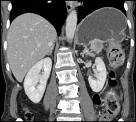 Pancreatic Tumor Invades the Spleen - CTisus CT Scan