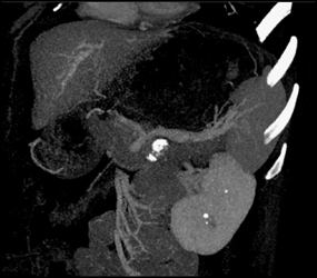 Splenic Artery Aneurysm Simulates A Pancreatic Mass - CTisus CT Scan