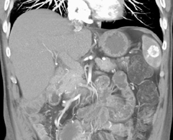 Splenic Hemangiomas - CTisus CT Scan