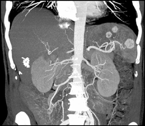 Splenic Hemangiomas - CTisus CT Scan