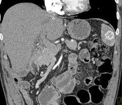 Splenic Hemangioma - CTisus CT Scan