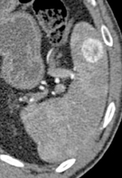 Splenic Hemangioma - CTisus CT Scan