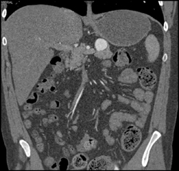 Splenic Artery Aneurysm - CTisus CT Scan