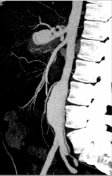 Splenic Artery Aneurysm - CTisus CT Scan