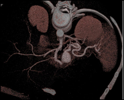 Splenic Artery Aneurysm - CTisus CT Scan