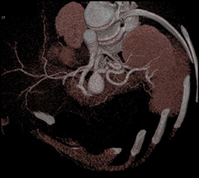 Splenic Artery Aneurysm - CTisus CT Scan