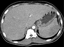 Splenic Lymphoma - CTisus CT Scan