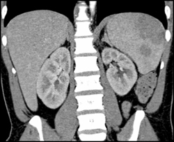 Splenic Lymphoma - CTisus CT Scan