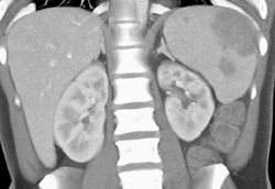 Splenic Lymphoma - CTisus CT Scan