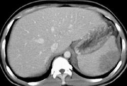 Splenic Lymphoma - CTisus CT Scan