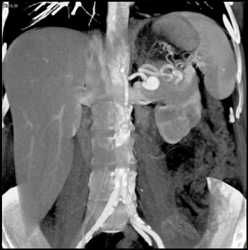 Splenic Artery Aneurysm - CTisus CT Scan