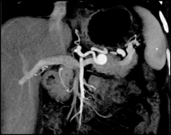 Splenic Artery Aneurysm - CTisus CT Scan