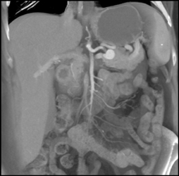 Splenic Artery Aneurysm - CTisus CT Scan