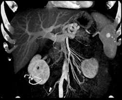 Splenic Hemangiomas - CTisus CT Scan