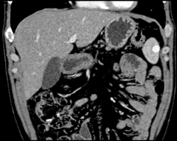 Splenic Hemangiomas - CTisus CT Scan