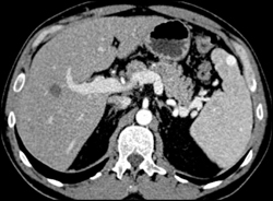 Splenic Hemangiomas - CTisus CT Scan