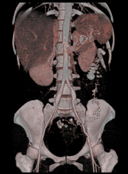 Splenic Artery Aneurysm - CTisus CT Scan