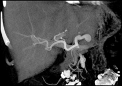 Splenic Artery Aneurysm - CTisus CT Scan