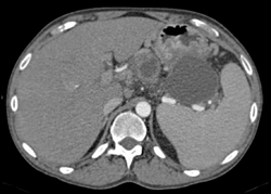 Pancreatic Pseudocysts Occlude the Splenic Veins - CTisus CT Scan