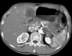 Pancreatic Cancer Encases the Splenic Artery - CTisus CT Scan