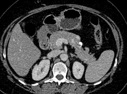 Splenic Artery Aneurysm - CTisus CT Scan