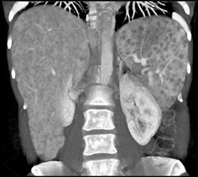 Sarcoidosis - CTisus CT Scan