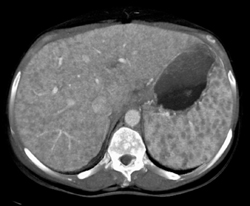 Sarcoidosis - CTisus CT Scan