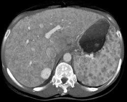 Sarcoidosis - CTisus CT Scan