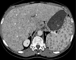 Sarcoidosis - CTisus CT Scan