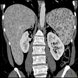 Sarcoidosis - CTisus CT Scan