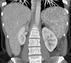 Sarcoidosis - CTisus CT Scan