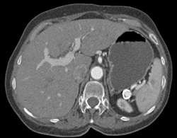 Splenic Artery Aneurysm - CTisus CT Scan