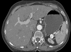 Splenic Artery Aneurysm - CTisus CT Scan